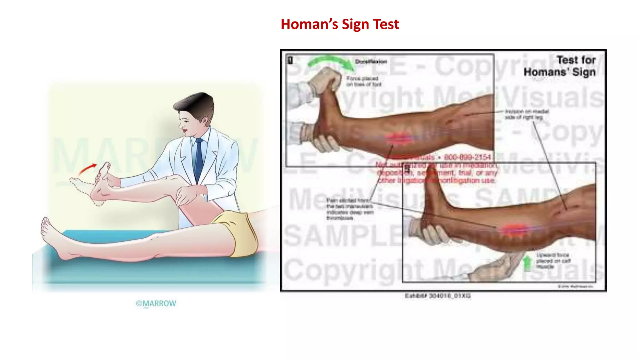 DEEP VEIN THROMBOSIS - Copy.pptx