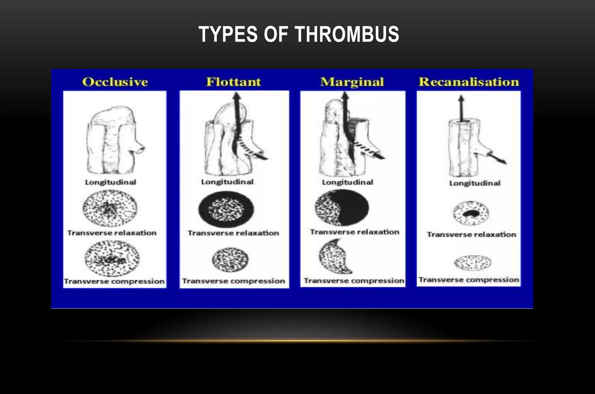 TYPES OF THROMBUS
 
