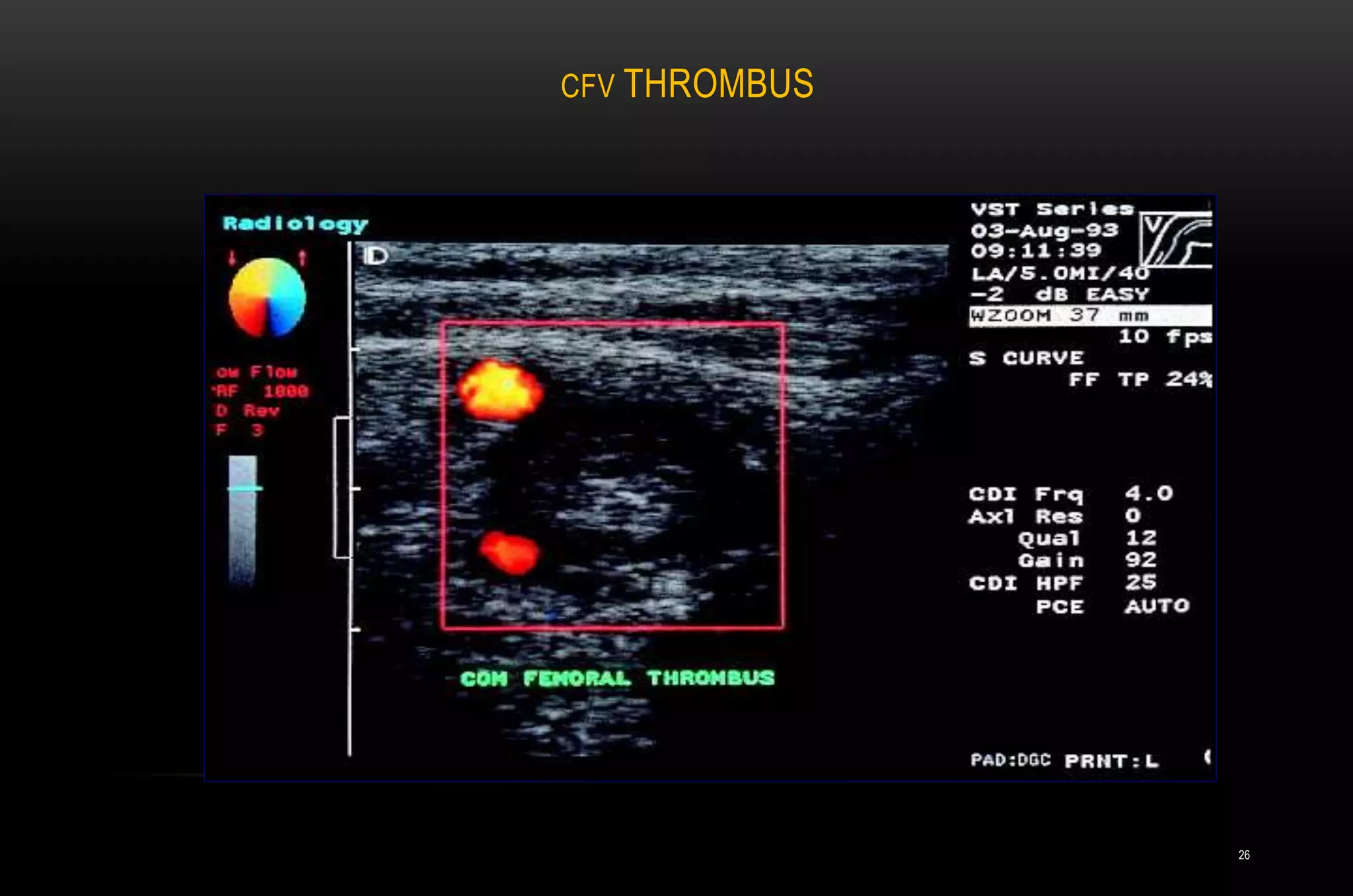 CFV THROMBUS
26
 
