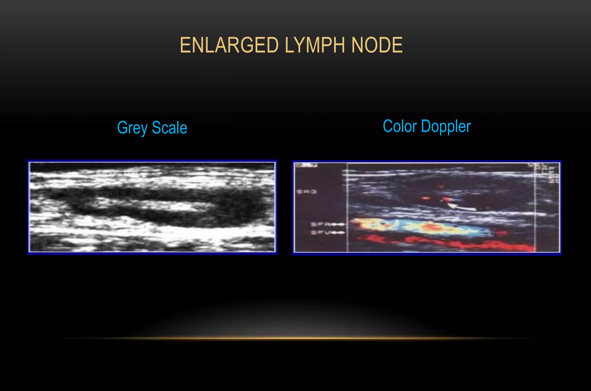 ENLARGED LYMPH NODE
Grey Scale Color Doppler
 