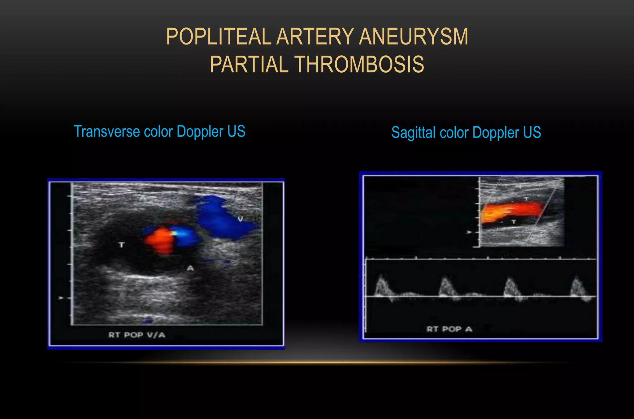 POPLITEAL ARTERY ANEURYSM
PARTIAL THROMBOSIS
Transverse color Doppler US Sagittal color Doppler US
 