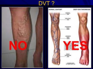 Dvt Racgp Deep vein thrombosis and Pulmonary embolism 2014 | PPTX