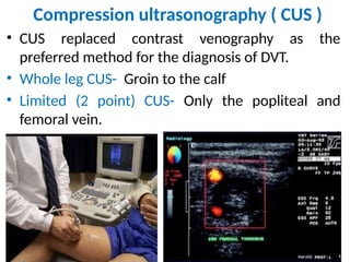 Cus Method Comprehensive Overview of Deep Vein Thrombosis and Pulmonary Embolism ...