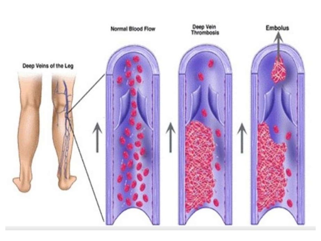 Deep vein thrombosis (DVT) and Pulmonary embolism (PE)