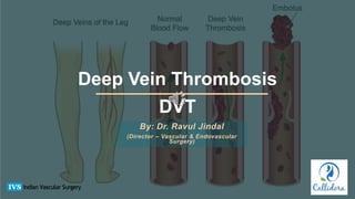 Deep Vein Thrombosis
DVT
By: Dr. Ravul Jindal
(Director – Vascular & Endovascular
Surgery)
 