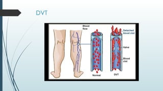 DEEP VENOUS THROMBOSIS(DVT)- A Presentation.pptx