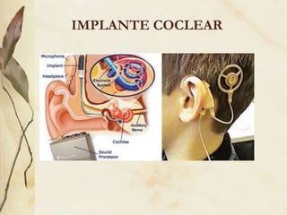 IMPLANTE COCLEAR
 