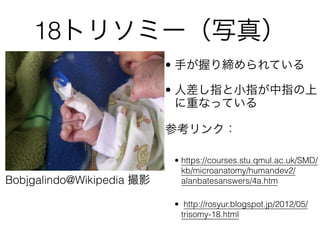 18ȥ꥽ߩ`д棩
Bobjgalindo@Wikipedia Ӱ
? ֤դ꾆Ƥ
? ˲ָСָָ
ؤʤäƤ
ο󥯣
? https://courses.stu.qmul.ac.uk/SMD/
kb/microanatomy/humandev2/
alanbatesanswers/4a.htm
? http://rosyur.blogspot.jp/2012/05/
trisomy-18.html
 