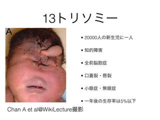 13ȥ꥽ߩ`
? 20000ˤһ
? ֪Ϻ
? ȫǰ×֢
? w?
? С֢?o֢
? һʤ5%
Chan A et al@WikiLectureӰ
 