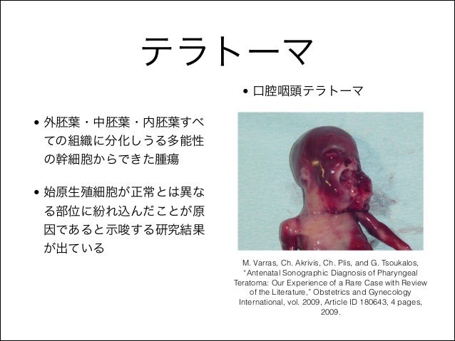 Images Of テラトーマ Japaneseclass Jp Images Of テラトーマ Japaneseclass Jp