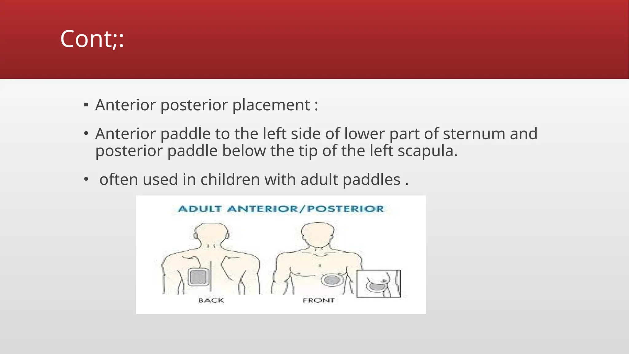 Cont;:
▪ Anterior posterior placement :
• Anterior paddle to the left side of lower part of sternum and
posterior paddle below the tip of the left scapula.
• often used in children with adult paddles .
 