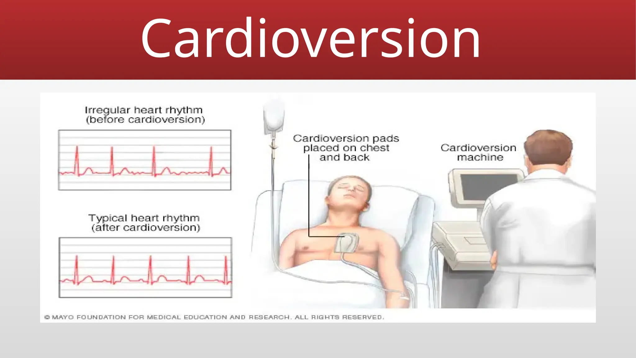 Cardioversion
 