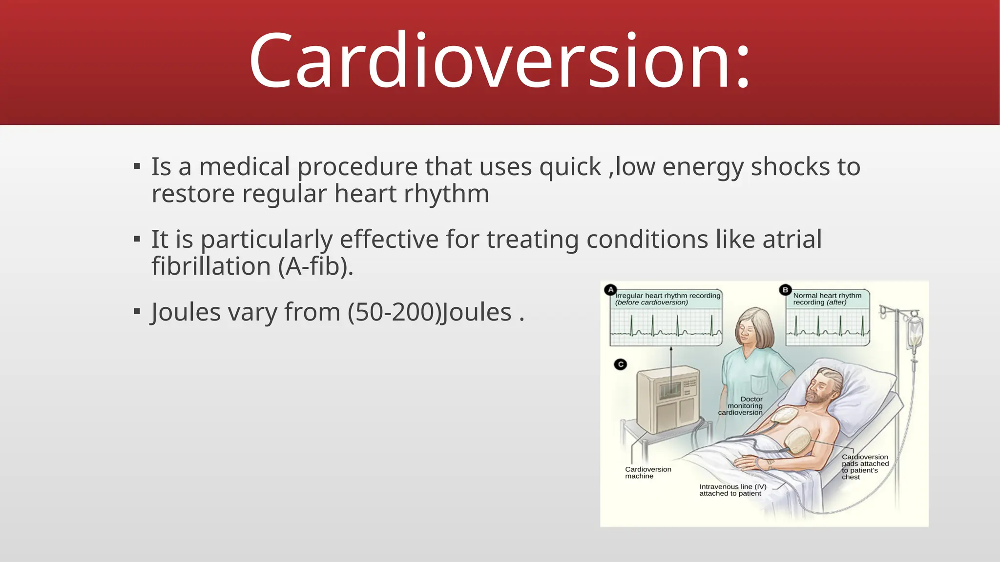 Cardioversion:
▪ Is a medical procedure that uses quick ,low energy shocks to
restore regular heart rhythm
▪ It is particularly effective for treating conditions like atrial
fibrillation (A-fib).
▪ Joules vary from (50-200)Joules .
 