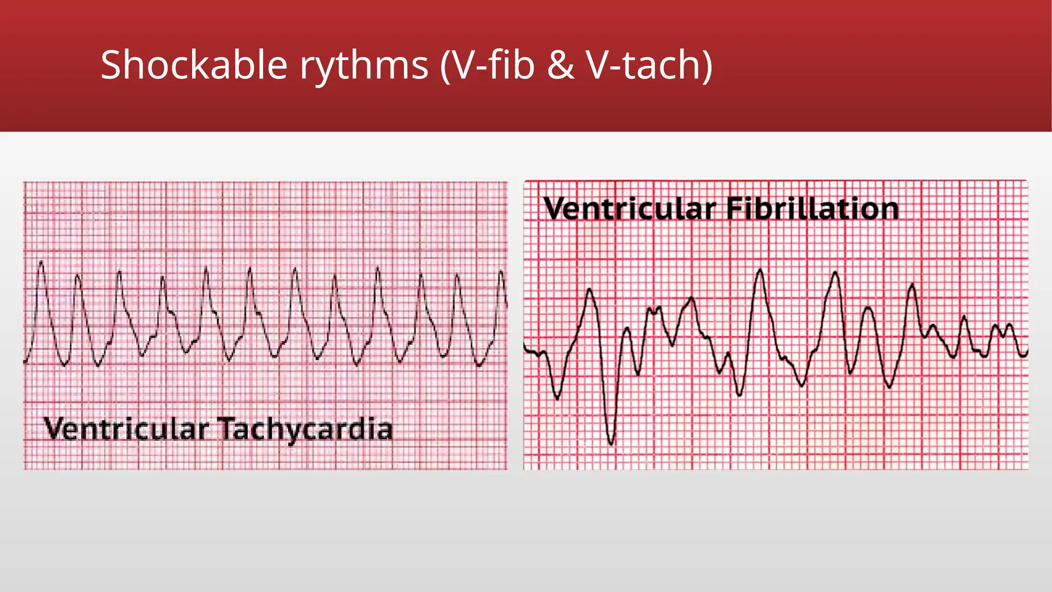 Shockable rythms (V-fib & V-tach)
 