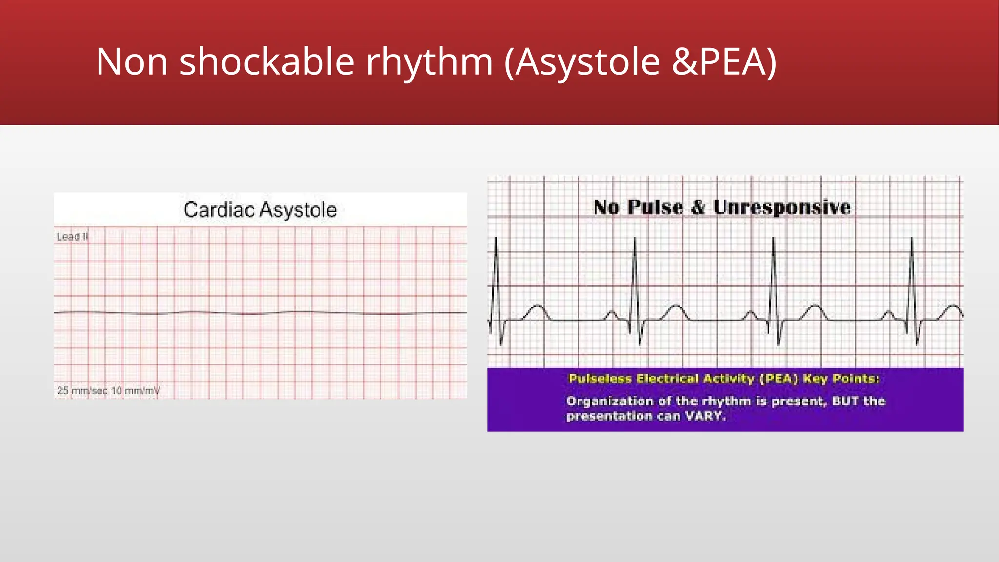 Non shockable rhythm (Asystole &PEA)
 