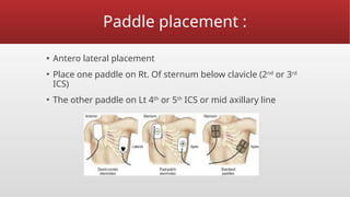 Paddle placement :
▪ Antero lateral placement
• Place one paddle on Rt. Of sternum below clavicle (2nd
or 3rd
ICS)
• The other paddle on Lt 4th
or 5th
ICS or mid axillary line
 