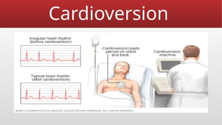 Cardioversion
 