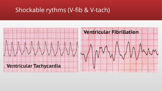 Shockable rythms (V-fib & V-tach)
 