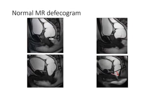 Defecogram Drawings Defecography (1).pptx
