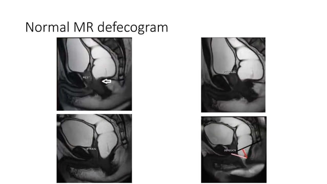 Defecography (1).pptx | Digestive Disorders | Diseases and Conditions