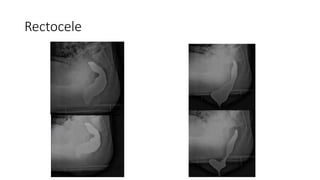 Defecography (1).pptx