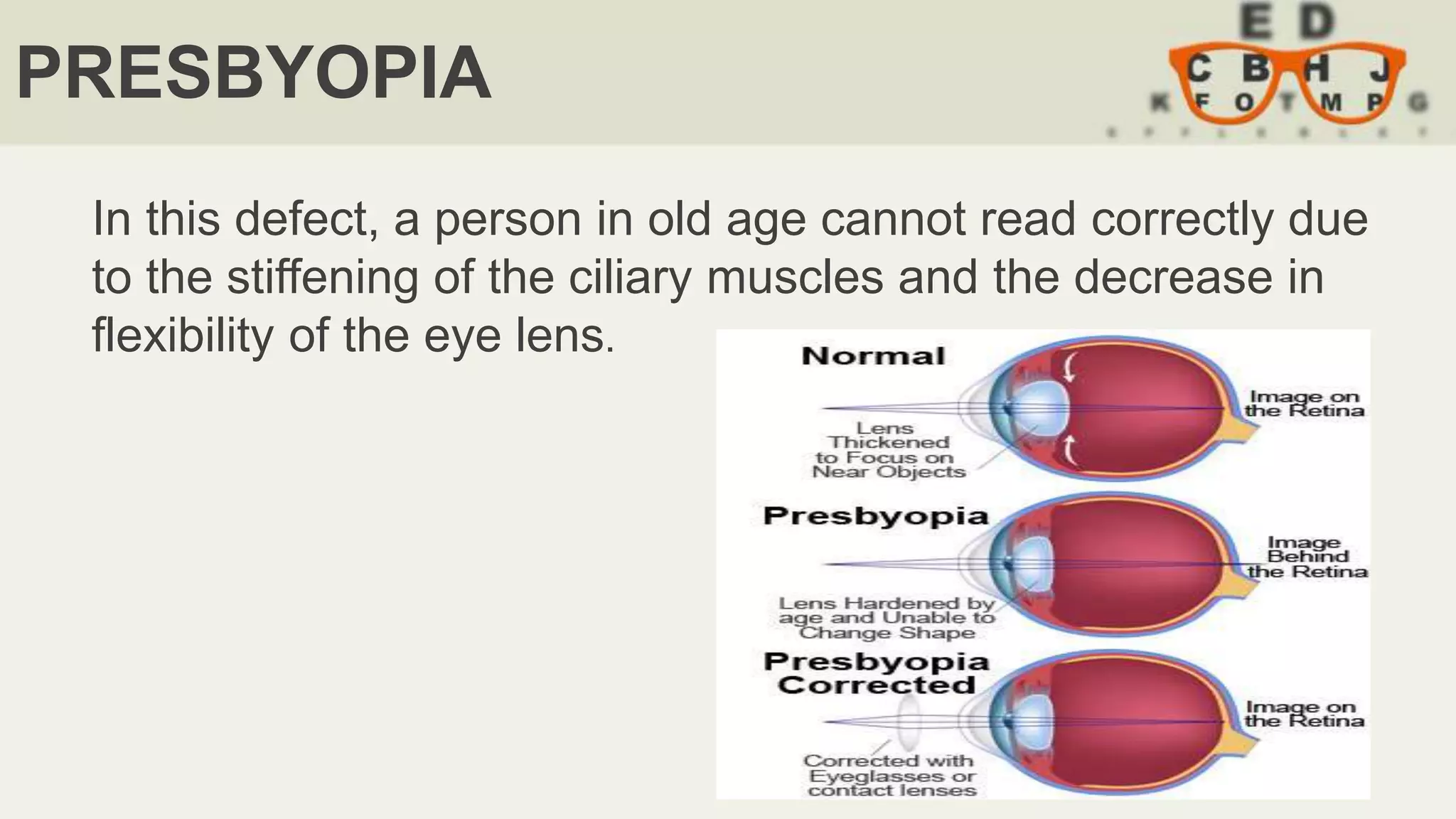 PRESBYOPIA
In this defect, a person in old age cannot read correctly due
to the stiffening of the ciliary muscles and the decrease in
flexibility of the eye lens.
 