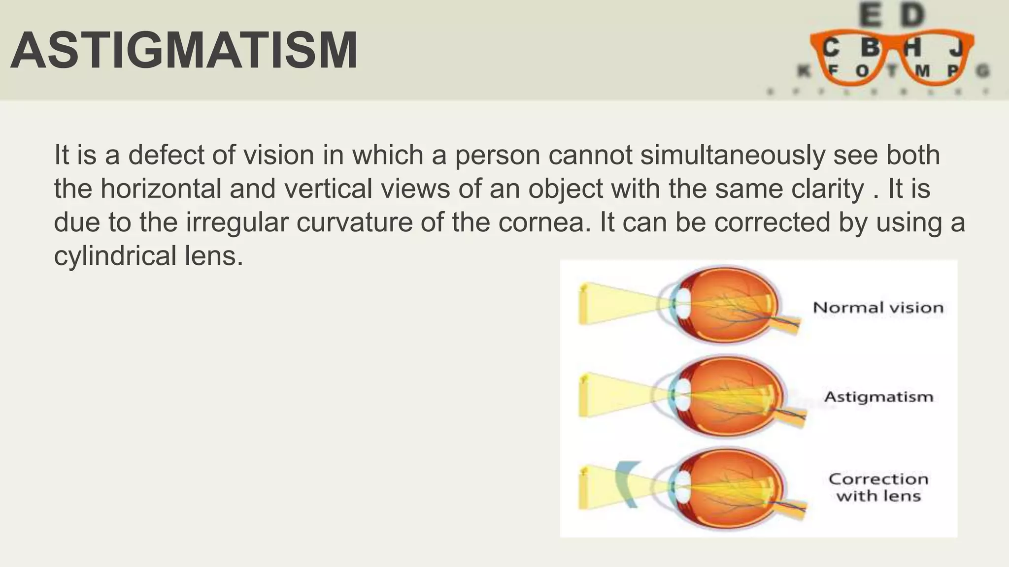 ASTIGMATISM
It is a defect of vision in which a person cannot simultaneously see both
the horizontal and vertical views of an object with the same clarity . It is
due to the irregular curvature of the cornea. It can be corrected by using a
cylindrical lens.
 