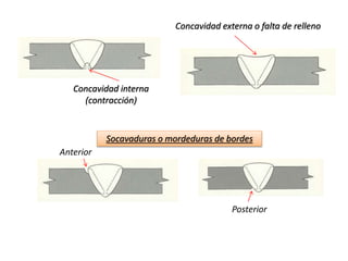 Concavidad interna 
(contracción) 
Socavaduras o mordeduras de bordes 
Posterior 
Anterior 
Concavidad externa o falta de relleno 
 