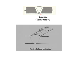 Quemado 
(No contracción) 
 