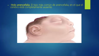  Holo anencefalia. El tipo más común de anencefalia, en el que el
cerebro está completamente ausente.
 