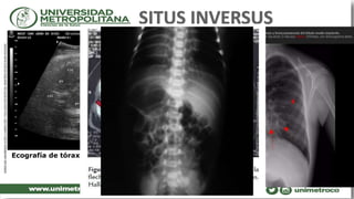 Ecografía de tórax fetal en situs inverso.
 
