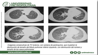 Imágenes consecutivas de TC torácica, con ventana de parénquima, que muestran la
disminución de tamaño del lóbulo pulmonar inferior izquierdo, con disminución del número y
tamaño de los vasos pulmonares.
 