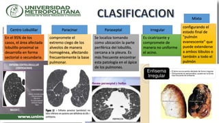 Centro Lobulillar ParaseptalParacinar Irregular
Mixto
En el 95% de los
casos, el área afectada
lobulillo proximal se
desarrolla en forma
sectorial o secundaria.
compromete el
extremo ciego de los
alveolos de manera
homogénea, afectando
frecuentemente la base
pulmonar.
Se localiza tomando
como ubicación la parte
periférica del lobulillo,
cercana a la pleura. Es
más frecuente encontrar
esta patología en el ápice
de los pulmones.
Es cicatrizante y
compromete de
manera no uniforme
el acino.
configurando el
estado final de
"pulmón
evanescente" que
puede extenderse
a ambos lóbulos o
también a todo el
pulmón
 