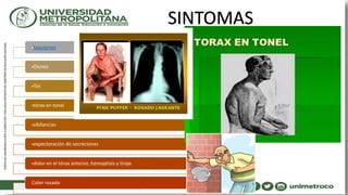 taquipnea
Disnea
Tos
tórax en tonel
sibilancias
expectoración de secreciones
dolor en el tórax anterior, hemoptisis y tiraje.
Color rosado
SINTOMAS
 
