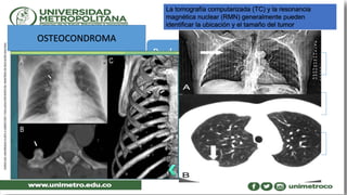 SINTOMAS
Clínica variable tumefacción, dolor
local y referido
DIAGNÓSTICO
Rx de torax
TAC
RMN
La tomografía computarizada (TC) y la resonancia
magnética nuclear (RMN) generalmente pueden
identificar la ubicación y el tamaño del tumor
OSTEOCONDROMA
 