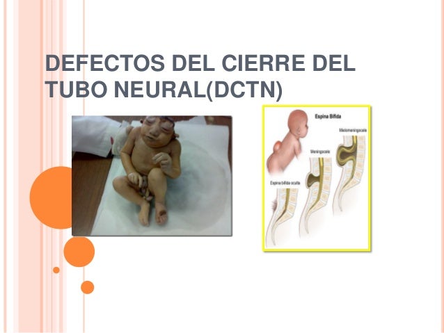 Defectos de cierre del tubo neural seminario
