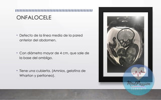 ONFALOCELE
• Defecto de la línea media de la pared
anterior del abdomen.
• Con diámetro mayor de 4 cm, que sale de
la base del ombligo.
• Tiene una cubierta. (Amnios, gelatina de
Wharton y peritoneo).
 