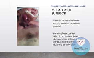 ONFALOCELE
SUPERIOR
• Defecto de la fusión de del
estrato somático de la hoja
caudal.
• Pentalogía de Cantrell.
(Hendidura esternal, hernia
diafragmática anterior, ectopia
cordis, defectos cardiacos y
ausencia de pericardio)
 