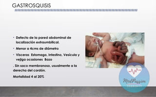 • Defecto de la pared abdominal de
localización extraumbilical.
• Menor a 4cms de diámetro
• Visceras Estomago, Intestino, Vesícula y
vejiga ocasiones Bazo
. Sin saco membranoso, usualmente a la
derecha del cordón.
Mortalidad 4 al 20%
GASTROSQUISIS
 