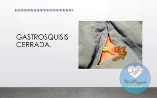 GASTROSQUISIS
CERRADA.
 