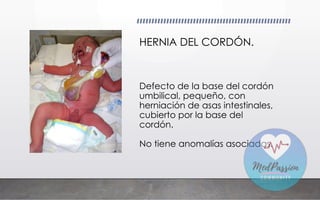 Defecto de la base del cordón
umbilical, pequeño, con
herniación de asas intestinales,
cubierto por la base del
cordón.
No tiene anomalías asociadas.
HERNIA DEL CORDÓN.
 