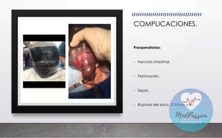COMPLICACIONES.
Preoperatorias:
- Necrosis intestinal.
- Perforación.
- Sepsis.
- Ruptura del saco. (Onfalocele).
 