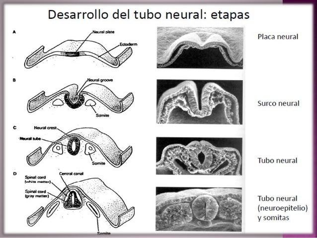 Defectos del tubo neural