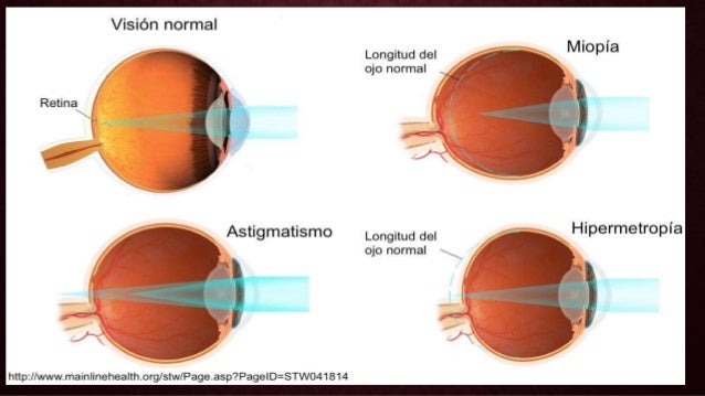 Resultado de imagen para errores de refraccion