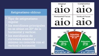 Astigmatismo oblicuo
• Tipo de astigmatismo
regular
• los meridianos principales
no se sitúan en 20° de la
horizontal y vertical.
• los meridianos de
curvatura máximo y
mínimo no coincide con el
vertical y horizontal
 