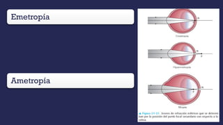 Emetropía
• Es el estado refractivo del ojo
fisiológicamente normal, en el cual los
rayos luminosos que llegan paralelos
de un objeto distante, con la
acomodación relajada, quedan
enfocados en el plano de la retina,
dando una imagen nítida del objeto.
Ametropía
• Es la situación en la que los rayos de
luz paralelos enfocan delante o detrás
del plano de la retina y la imagen de un
objeto lejano es borrosa
 