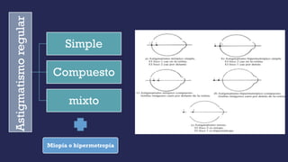 Miopía o hipermetropía
Astigmatismo
regular
Simple
Compuesto
mixto
 