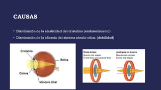 CAUSAS
• Disminución de la elasticidad del cristalino (endurecimiento)
• Disminución de la eficacia del sistema zónulo-ciliar. (debilidad)
 