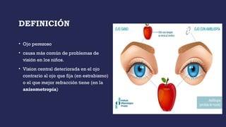 DEFINICIÓN
• Ojo perezoso
• causa más común de problemas de
visión en los niños.
• Vision central deteriorada en el ojo
contrario al ojo que fija (en estrabismo)
o el que mejor refracción tiene (en la
anisometropía)
 