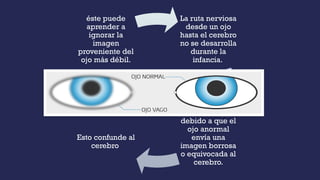 La ruta nerviosa
desde un ojo
hasta el cerebro
no se desarrolla
durante la
infancia.
debido a que el
ojo anormal
envía una
imagen borrosa
o equivocada al
cerebro.
Esto confunde al
cerebro
éste puede
aprender a
ignorar la
imagen
proveniente del
ojo más débil.
 